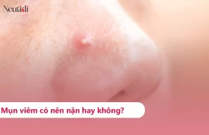 Mụn viêm có nên nặn mụn viêm không?