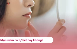 Mụn viêm có tự hết hay không?