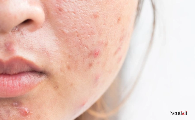 Mụn viêm có tự hết hay không?