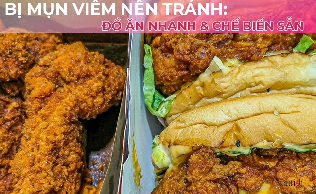 Mụn viêm nên hạn chế đồ ăn nhanh, đồ ăn chế biến sẵn