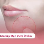 8 Lý Do Gây Mụn Viêm Ở Cằm & Cách Trị Hiệu Quả Bạn Nên Biết Mụn viêm ở cằm là gì