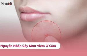 Mụn viêm ở cằm là gì