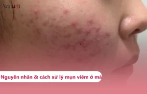Mụn viêm ở má: Nguyên nhân và cách điều trị