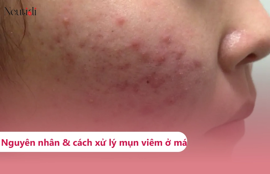 Mụn viêm ở má: Nguyên nhân và cách điều trị