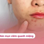 4 Lý Do Bị Nổi Mụn Viêm Quanh Miệng & Cách Khắc Phục Hiệu Quả Tìm hiểu về mụn viêm quanh miệng