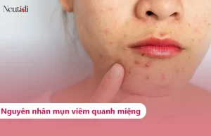 Tìm hiểu về mụn viêm quanh miệng