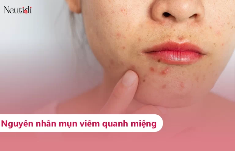 Tìm hiểu về mụn viêm quanh miệng
