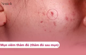 Thâm đỏ sau mụn
