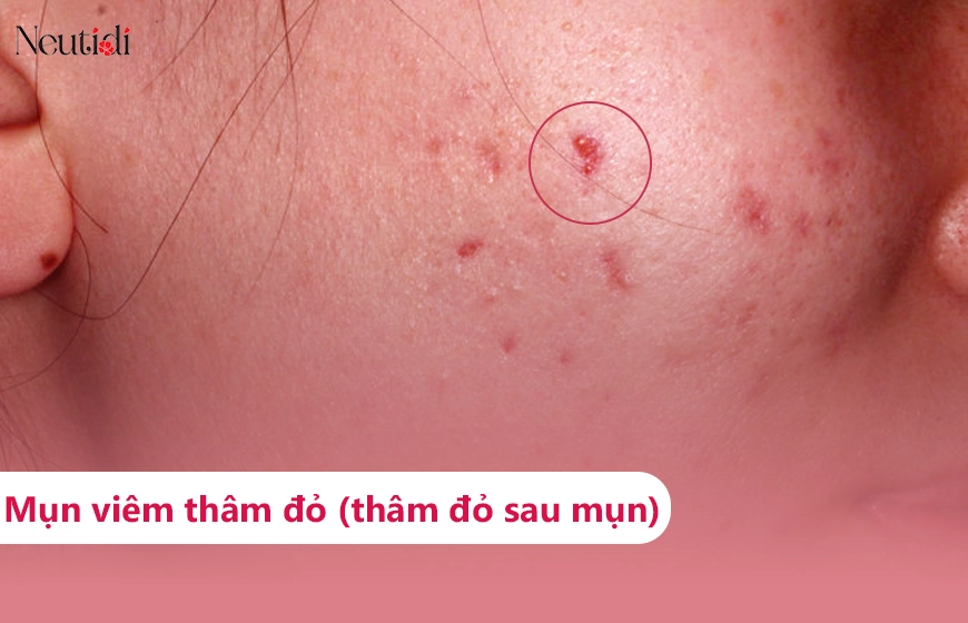 Thâm đỏ sau mụn