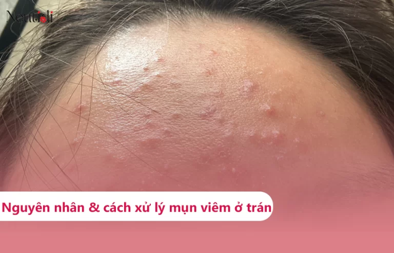 Tìm hiểu về mụn viêm trên trán