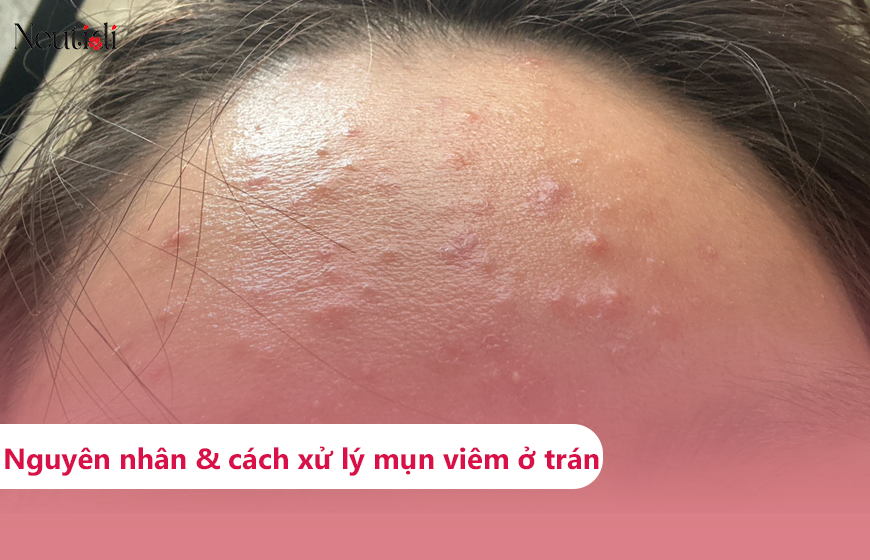 Tìm hiểu về mụn viêm trên trán