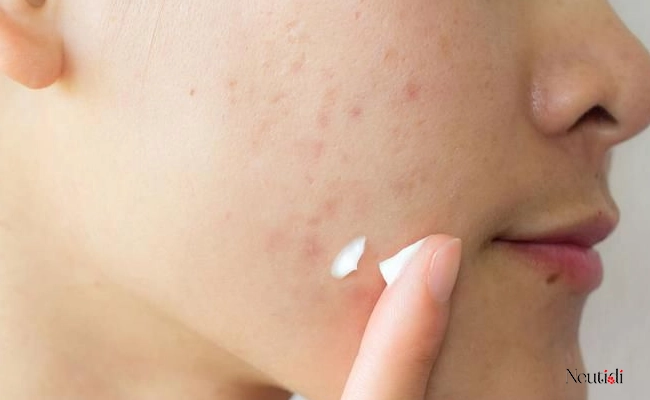 Lưu ý về thời điểm dùng thuốc kháng sinh trị mụn
