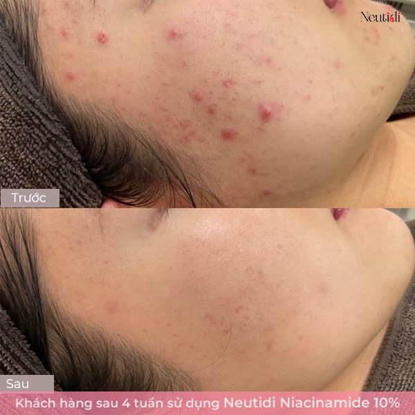 Serum Neutidi Niacinamide giúp làm giảm mụn viêm ở má hiệu quả sau 4 tuần