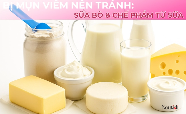 Hạn chế dùng sữa bò và các chế phẩm từ sữa khi đang bị mụn viêm