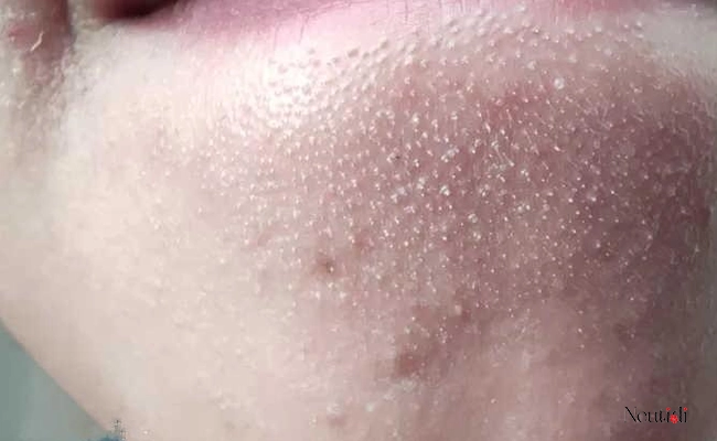 8 Lý Do Gây Mụn Viêm Ở Cằm & Cách Trị Hiệu Quả Bạn Nên Biết 3 Nguyên nhân khiến cằm nổi mụn viêm
