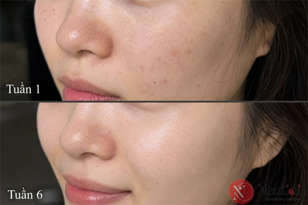Đánh giá Serum SVR Sebiaclear hỗ trợ làm giảm thâm mụn