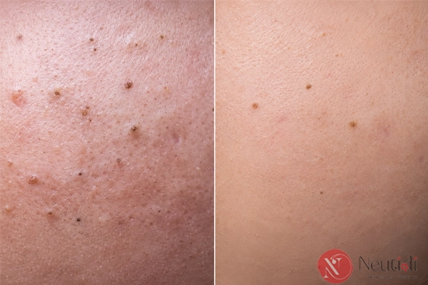 TOP 5 serum trị mụn đầu đen và mụn ẩn cho da dầu & da khô 3 Review serum trị mụn đầu đen và mụn ẩn COSRX BHA Blackhead Power Liquid