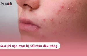 Vì sao nặn mụn xong bị nổi mụn đầu trắng