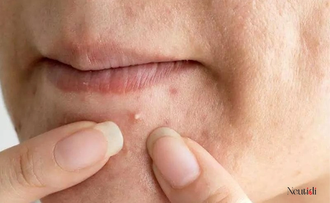 Sau khi nặn mụn có nên dùng Niacinamide không? 2 Sau khi nặn mụn có nên dùng niacinamide?