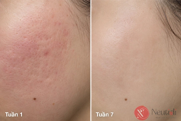 Review Serum Melano sau 7 tuần - hỗ trợ mờ thâm đỏ sau mụn