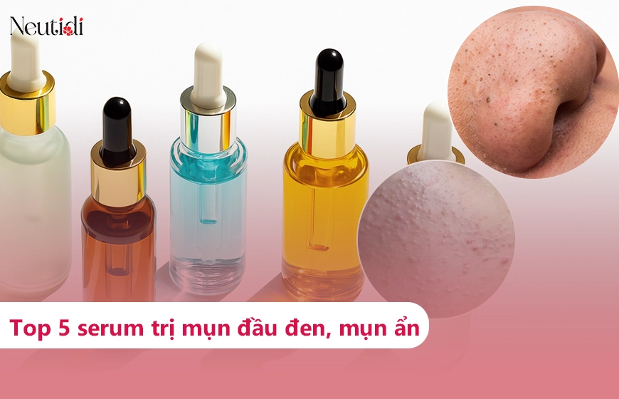 Review 5 serum trị mụn đầu đen và mụn ẩn đáng dùng, hiệu quả nhất 2025