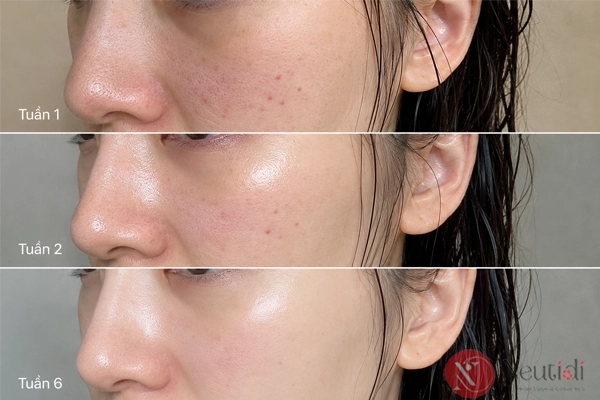 Trải nghiệm serum Neutidi Niacinamide 10% sau 6 tuần