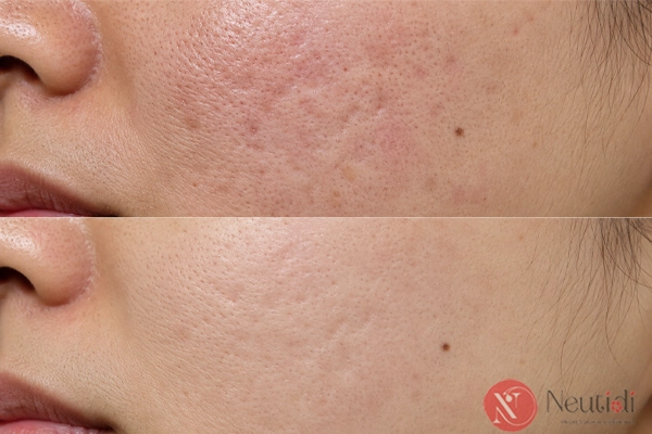 Review Serum Tirtir Azelaic Acid 12% làm mờ thâm đỏ, bớt đỏ da