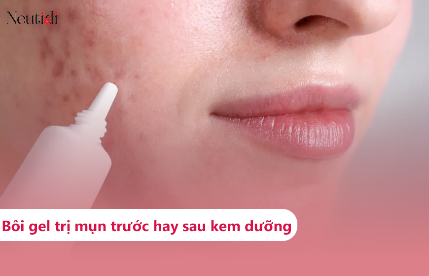 Bôi gel trị mụn trước hay sau kem dưỡng