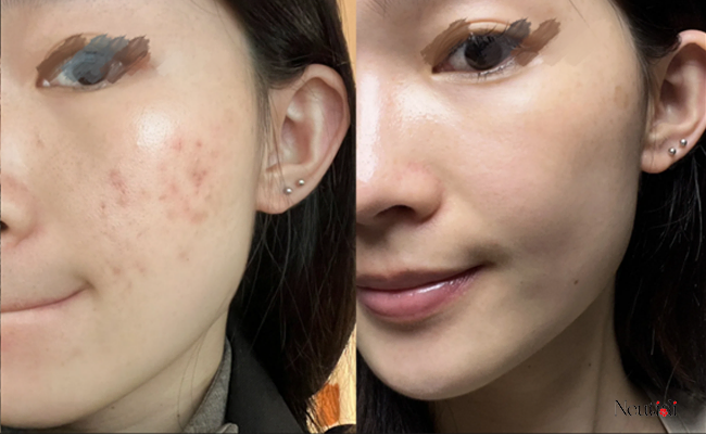 Tác dụng của serum trị mụn viêm