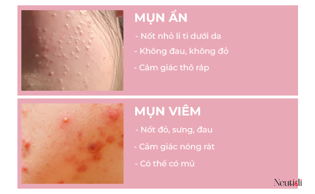 Nổi mụn ẩn, mụn viêm khi dùng niacinamide