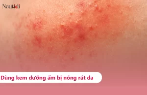 Dùng kem dưỡng ẩm bị rát mặt, nóng mặt