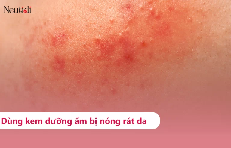 Dùng kem dưỡng ẩm bị rát mặt, nóng mặt