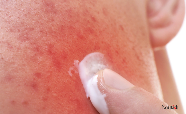 Tìm hiểu về tình trạng nóng mặt, rát da khi dùng kem dưỡng ẩm