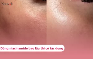 Dùng niacinamide bao lâu thì có tác dụng