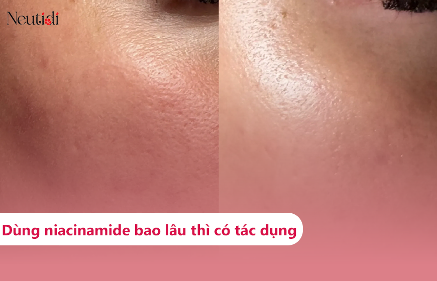 Dùng niacinamide bao lâu thì có tác dụng