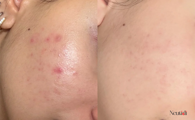Dùng niacinamide bao lâu thì giảm mụn