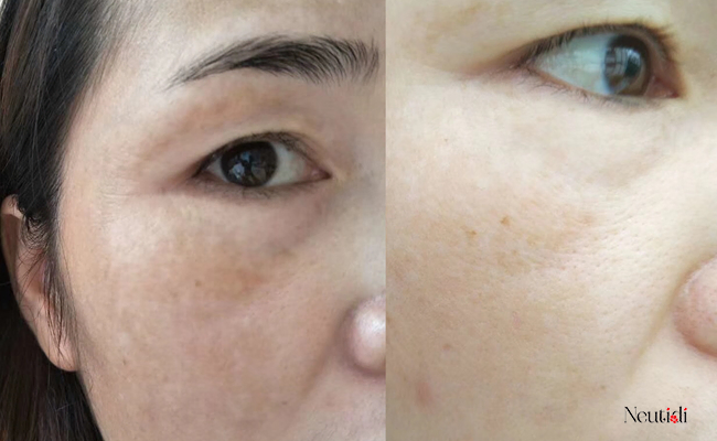 Dùng niacinamide bao lâu thì mờ thâm và sáng da?