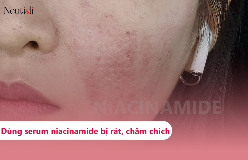 Vì sao dùng niacinamide bị châm chích?