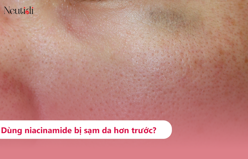 Dùng niacinamide bị thâm sạm da