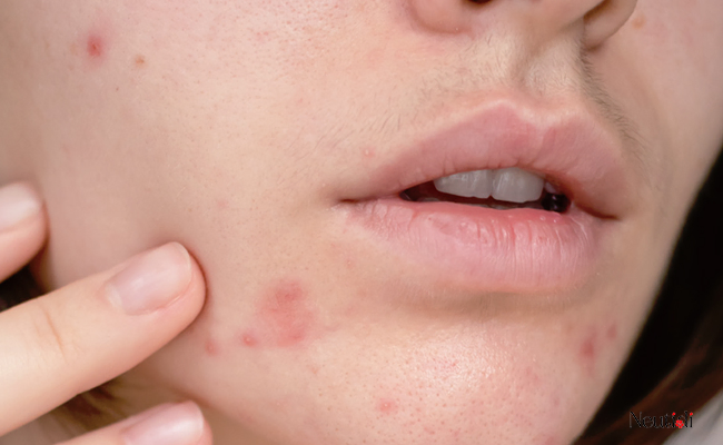 Cách khắc phục kích ứng do tretinoin