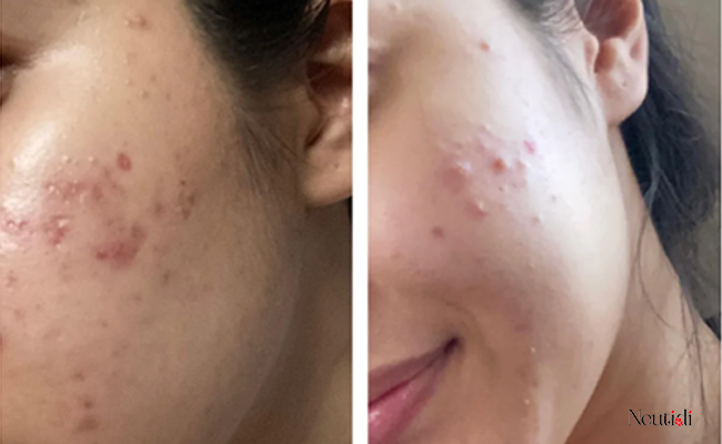 Lợi ích khi kết hợp dùng chung niacinamdie với adapalene