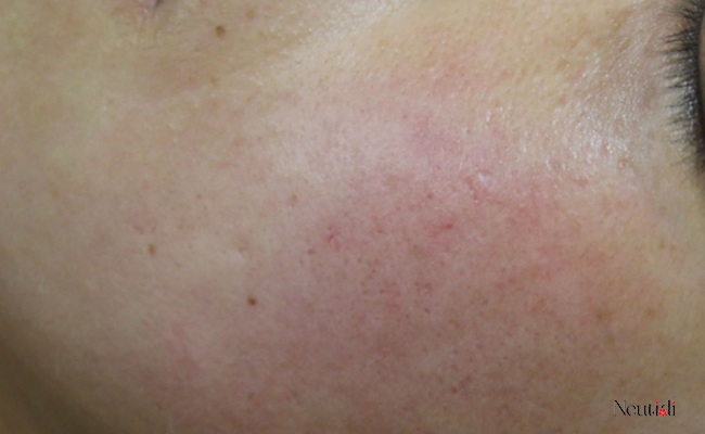 Nguyên nhân gây sạm da khi dùng niacinamide