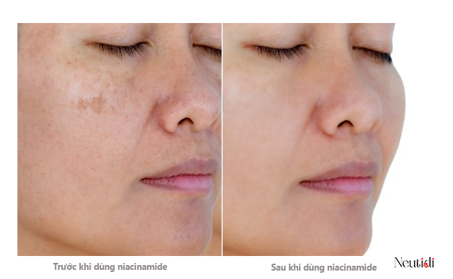 Hiệu quả trị thâm, làm mờ đốm nâu của niacinamide