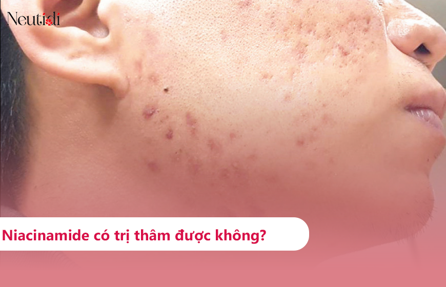 Niacinamide có trị thâm được không?