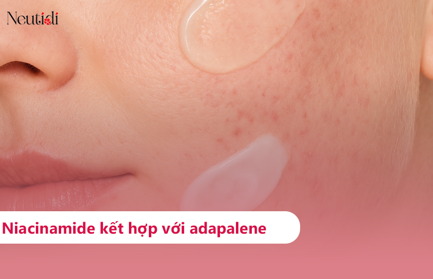 Kết hợp niacinamide với adapalene