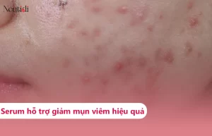 Review các loại serum trị mụn viêm hiệu quả