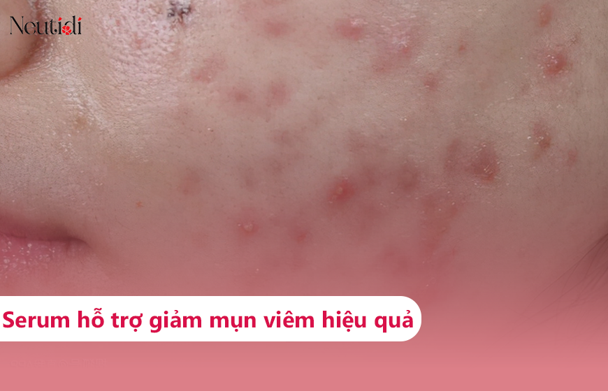 Review các loại serum trị mụn viêm hiệu quả