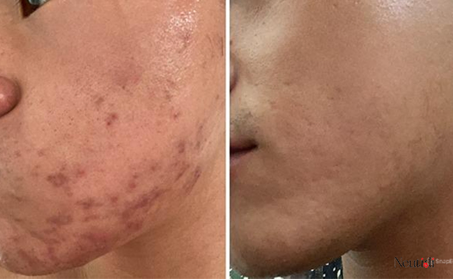 Cách trị thâm bằng niacinamide chi tiết