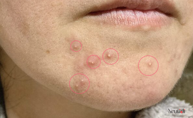 Vì sao bị nổi mụn khi dùng niacinamide?