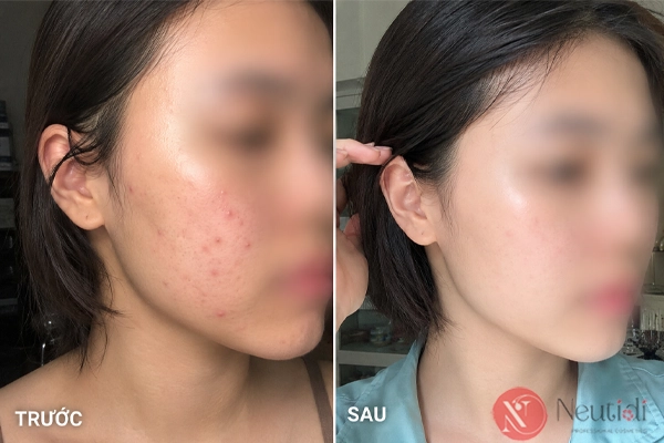 TOP 11 serum trị mụn cho da dầu tốt nhất 2026 (bác sĩ da liễu khuyên dùng) 12 Serum Eucerin có trị mụn?